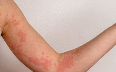 Resolving Cases of Hives and Other Skin Reactions