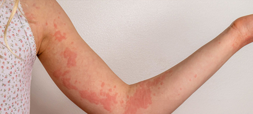 Resolving Cases of Hives and Other Skin Reactions